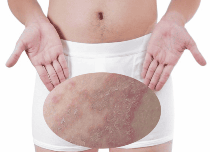 Ngứa bìu về đêm là dấu hiệu của bệnh lý gì và cách xử lý?