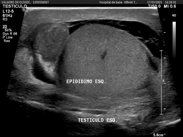 Hình ảnh siêu âm một ca viêm tinh hoàn