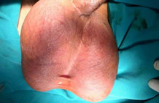 Thời gian điều trị viêm tinh hoàn phụ thuộc vào nhiều yếu tố