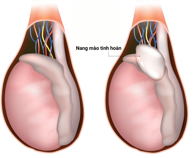 Nang Mào Tinh Hoàn:
