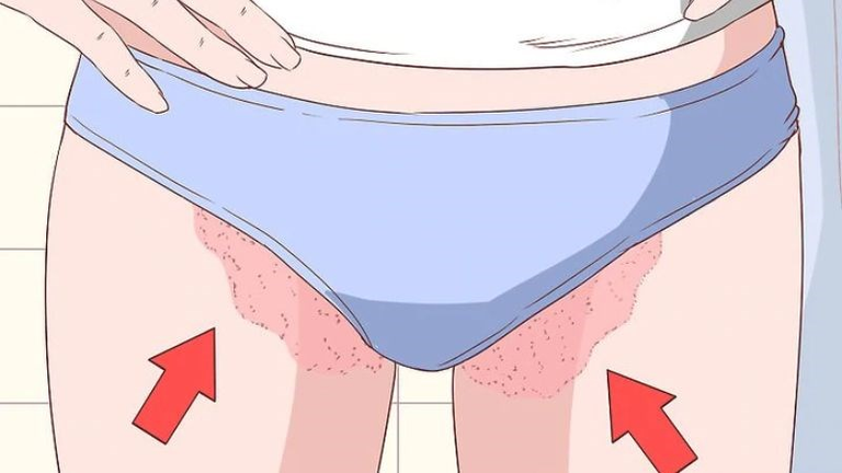 Nấm bẹn (tinea cruris): Nguyên nhân và cách chữa trị