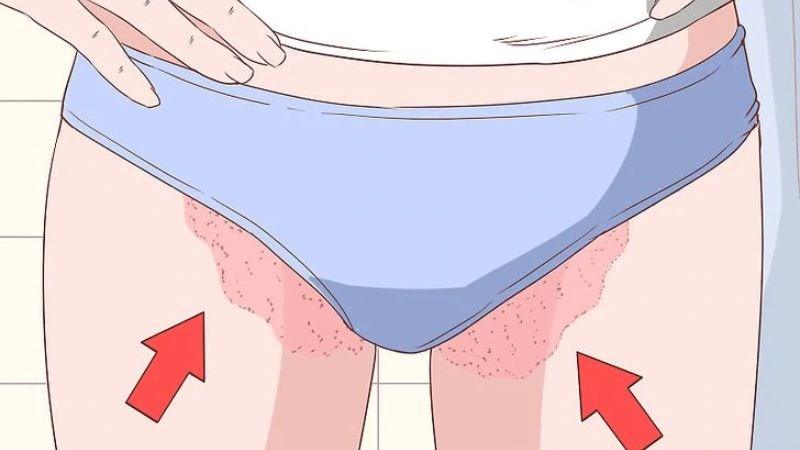 Nấm bẹn (tinea cruris): Nguyên nhân và cách chữa trị