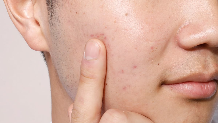 Mụn tuổi dậy thì ở nam nên chăm sóc thế nào để hạn chế sẹo?