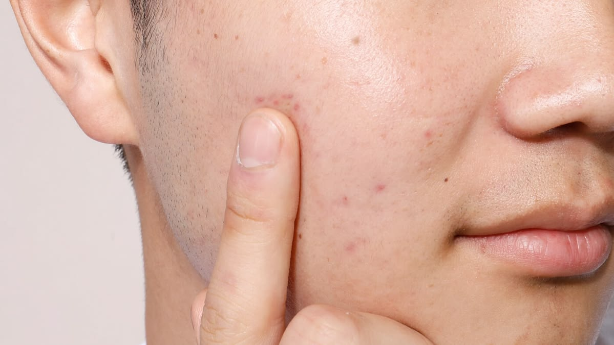 Mụn tuổi dậy thì ở nam nên chăm sóc thế nào để hạn chế sẹo?