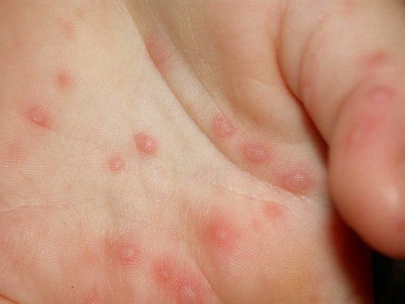 Giang mai: Nguyên nhân, dấu hiệu, chẩn đoán và phương pháp điều trị
