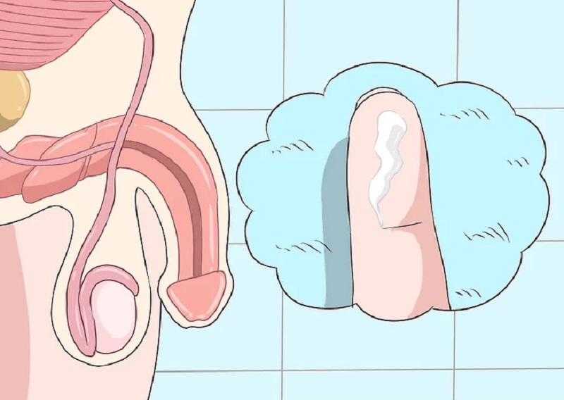 Bệnh lậu ở nam giới: Nguyên nhân, dấu hiệu, chẩn đoán và phác đồ điều trị chuẩn y khoa